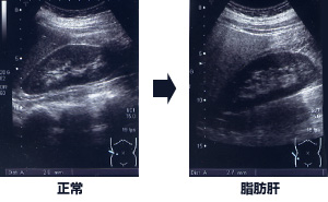 脂肪肝の超音波検査画像